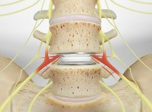 Artificial Disc Replacement (in the Lumbar Spine)