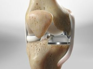 Partial Knee Replacement (With Oxford® Implant)