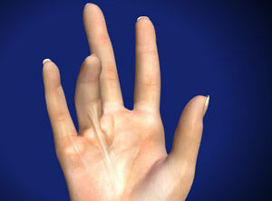 Limited Palmar Fasciectomy for Dupuytren’s Contracture