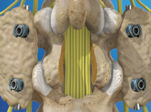 Spinal Fusion (Lumbar)