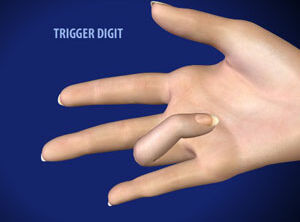 Trigger Digit Release